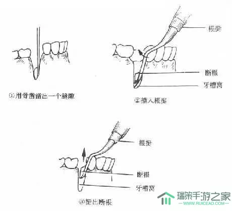 跨越星弧虎口拔牙流程